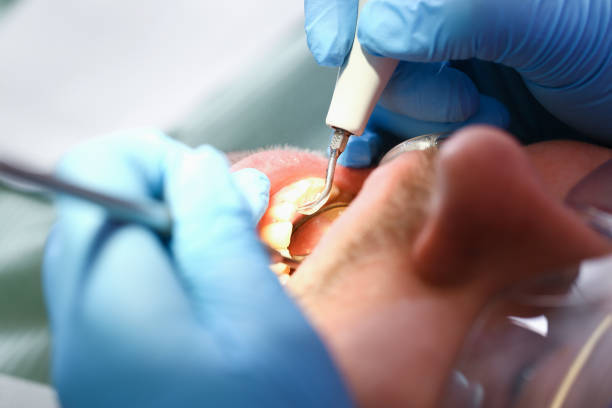 Best Emergency Root Canal Treatment in Dalton, GA